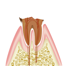 歯冠部が崩壊した状態（C4）