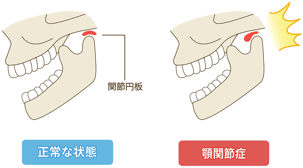 顎関節症