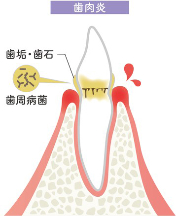 歯肉炎