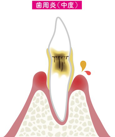 中度歯周炎